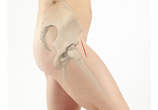 Direct Anterior Approach Hip Replacement