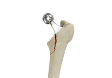 Femur Fractures