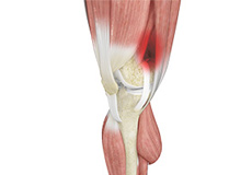 Iliotibial Band Syndrome