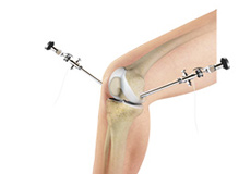 Knee Arthroscopy