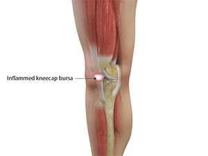 Kneecap Bursitis