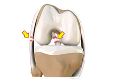 Multiligament Knee Reconstructions