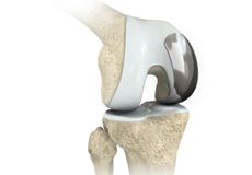 Partial Knee Replacement