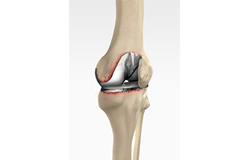 Revision Knee Replacement