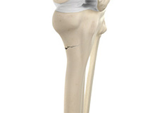 Hip Fractures