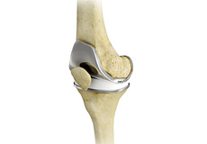 Total Knee Replacement